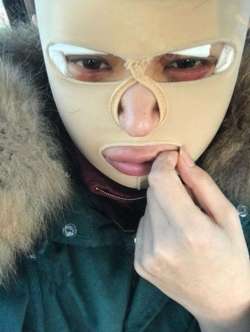 韩国做面部吸脂后要戴多久头套
