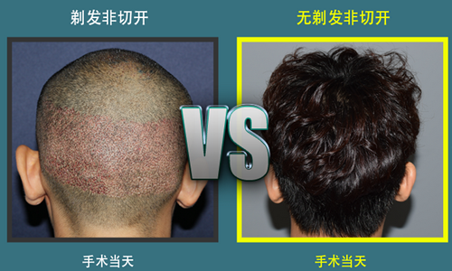 韩国多娜植发对比