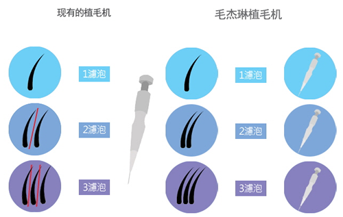 毛杰琳整形外科技术示意图