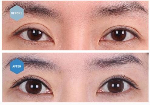 韩国修复双眼皮大概需要多少钱？韩国修复双眼皮哪家做的好？