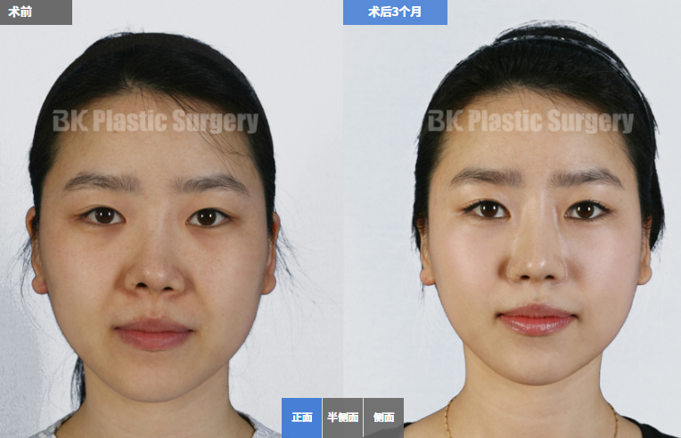 韩国BK鼻部整形案例