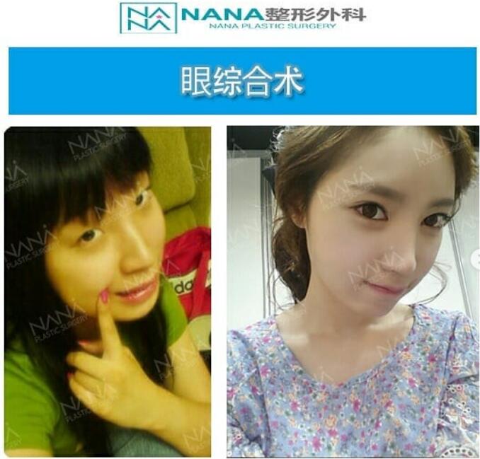 韩国娜娜NANA整形外科