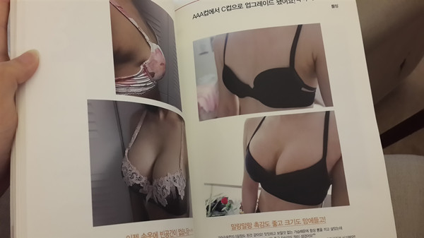 韩国假体隆胸案例