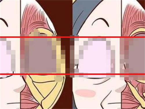 玻尿酸栓塞组织对比动画.png