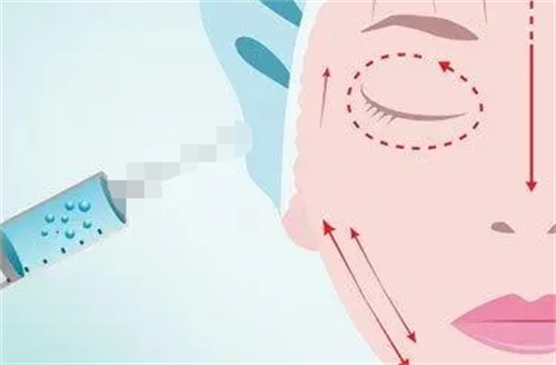 玻尿酸面部填充示意图.png