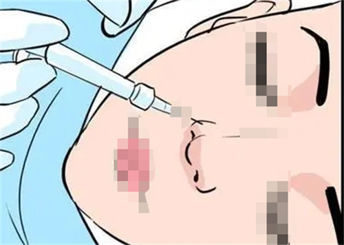 玻尿酸注射鼻子动画展示.png
